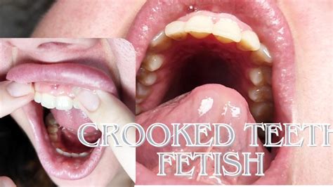 Crooked Teeth Fetish MollyDolly Bbw Mouth MollyDolly Clips Sale