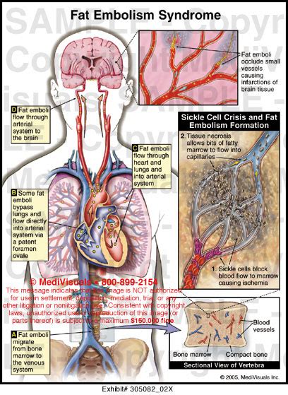 Fat Embolism Syndrome Medical Exhibit Medivisuals