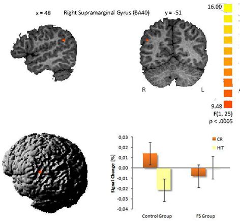 Interaction In The Right Supramarginal Gyrus Between Group And Item Download Scientific Diagram