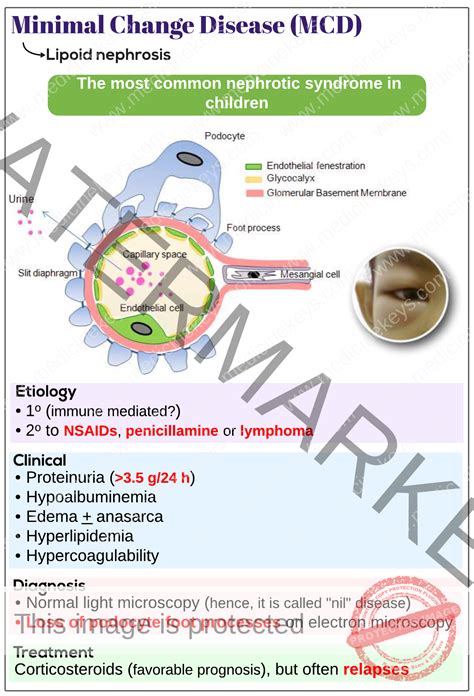 Minimal Change Disease Mcd Medicine Keys For Mrcps