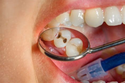 Obturación o empaste dental tipos y todo lo que debes saber Mejor