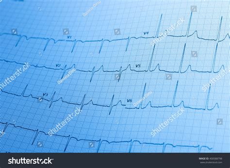 Electrocardiogram Ecg Printed On Graph Paper Foto Stock 400588798