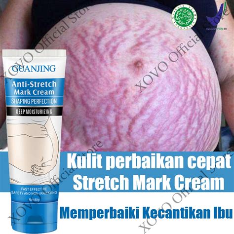 Jual Penghilang Strechmark Ampuh Permanen Bpom Stretch Mark Treatment