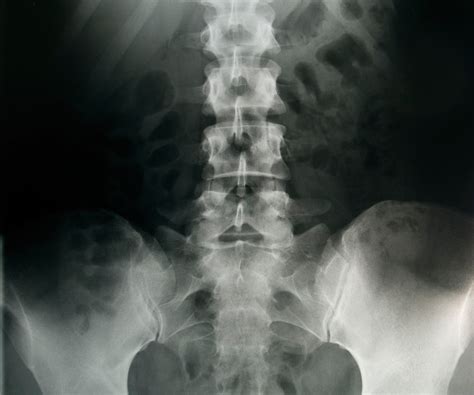 What To Expect With Back Surgery | HIDEF