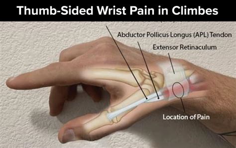 Thumb-Sided Wrist Pain in Climbers: A Case for De Quervain’s Tenosynovitis - The Climbing Doctor