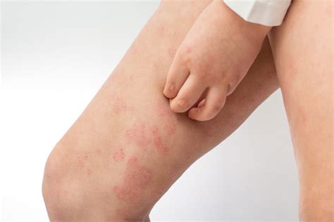 Atopische Dermatitis Linderung Bei Juckreiz Entz Ndungen