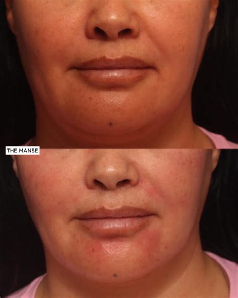 Nasolabial Fold Before And After