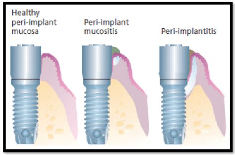 Peri Implantitis Periodontal Disease With Implants Artedental