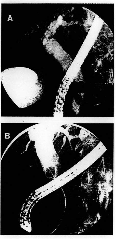 Figure 2 From Endoscopic Retrograde Cholangiopancreatography Semantic Scholar