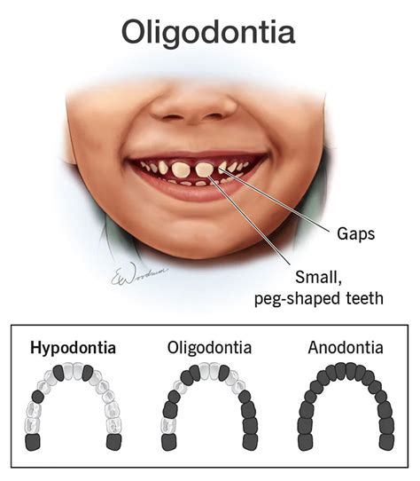 Oligodontia | Studio Dentaire