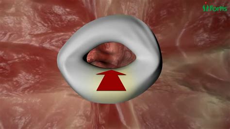 Endoscopic Mitral Valve Repair Minimally Invasive Cardiac Surgery