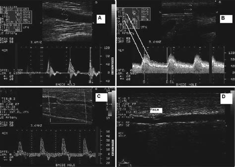 The Intimamedia Complex Is Depicted In Panel A For A Normal Brachial