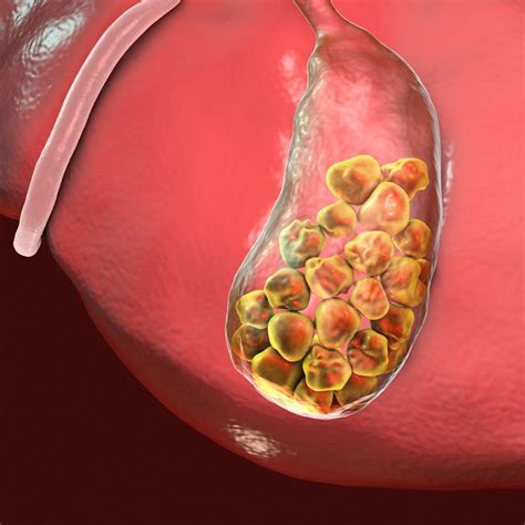 Passing Gallstones