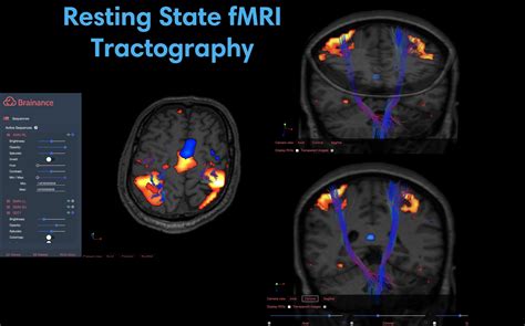 Functional MRI MRIcons