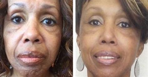 Facial Toning Exercises To Lift Saggy Face Skin And Remove Wrinkles And