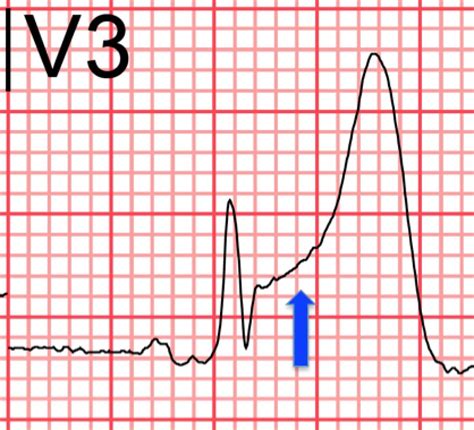 St Elevation Mi