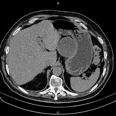 Gastrointestinal Stromal Tumor Of The Stomach Image Radiopaedia Org