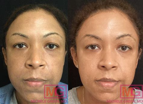 Prp Microneedling Benefits For Eye Area Haute Beauty Interview Dr Michele Green M D