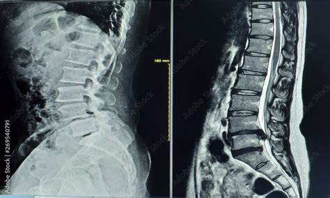 X Ray Image Two Views General X Ray And Mri Lumbar Spine Showing Herniated Nucleus Pulposus Of