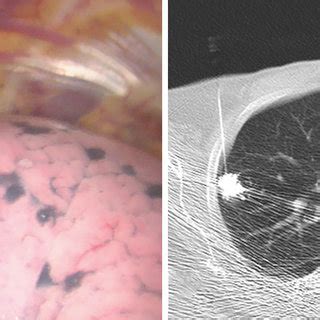 Preoperative Localization With Combined Lipiodol And Fluorescent Dye