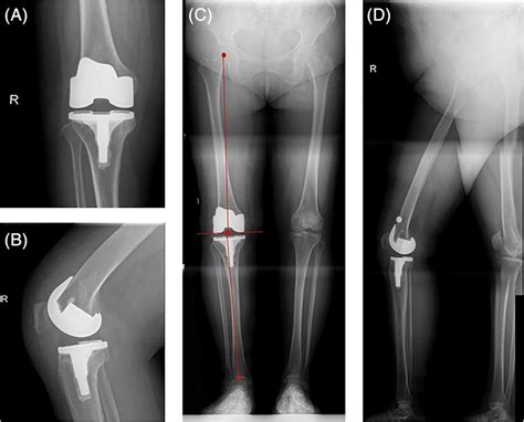 The Postoperative Radiographic Examination Of The Knee And The