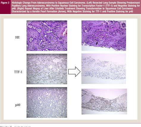 Figure 2 From Squamous Cell Carcinoma Transformation From Egfr‐mutated Lung Adenocarcinoma A