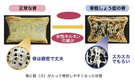 骨折と骨粗鬆症について 医療法人輝栄会 福岡輝栄会病院