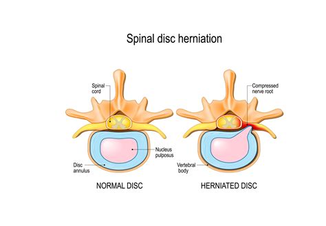 Lumbar Microdiscectomy Chibuikem Akamnonu Md