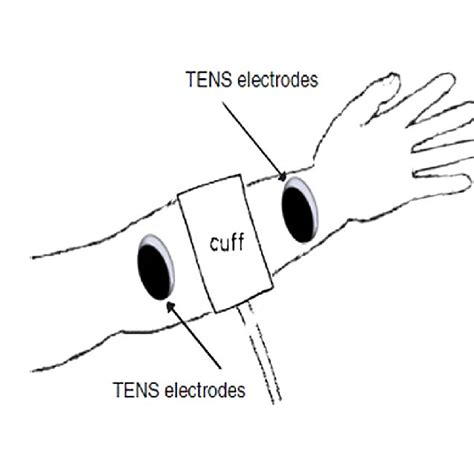 Position Of Transcutaneous Electrical Nerve Stimulation Tens