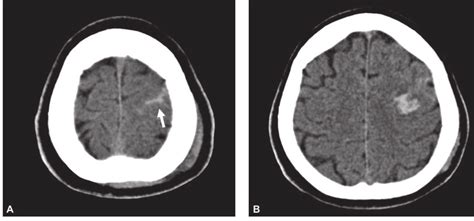 Cortes Axiais De Tomografia Computadorizada Cranioencef Lica Sem