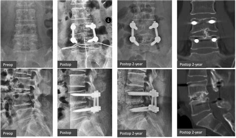 Frontiers Comparisons Of Oblique Lumbar Interbody Fusion And Transforaminal Lumbar Interbody