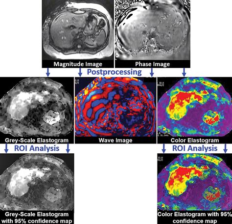 Liver Mr Elastography Technique And Image Interpretation Pearls And