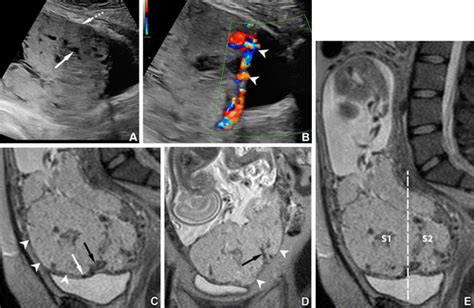 Placenta Accreta Spectrum Disorders Update And Pictorial Review Of The Sar Esur Joint Consensus