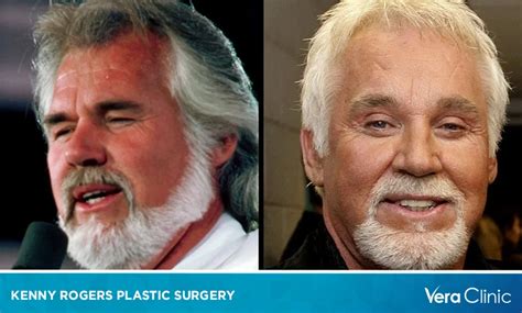 Kenny Rogers Plastic Surgery: Revealing the Change