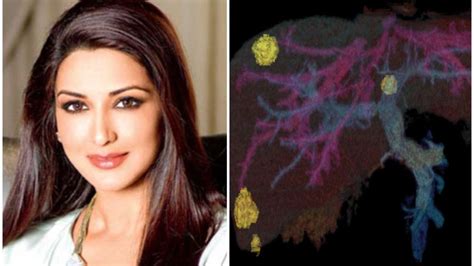 Sonali Bendre Battling Metastatic Cancer Why It Is Dangerous All You