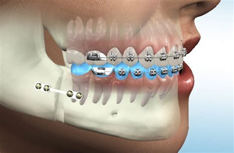 Oral & Maxillofacial Surgery – Java Dent