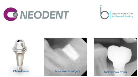 Neodent Dental Implant Brighton Implant Clinic Dental Implants