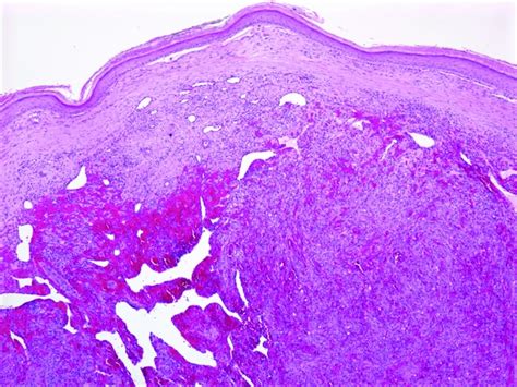 A Low Power View Of A Nodular Stage Kaposis Sarcoma Lesion The Dermis