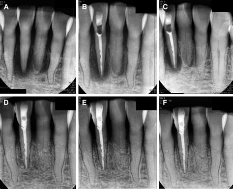 Periapical Radiography Of Case B A Initial Radiography B