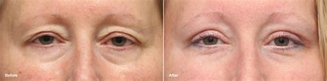 Upper Eyelid Surgery Photos | Princeton, NJ | Patient 9374