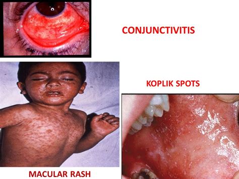 Dermal Manifestations In Viral Diseases In Children Dr Binod Kumar