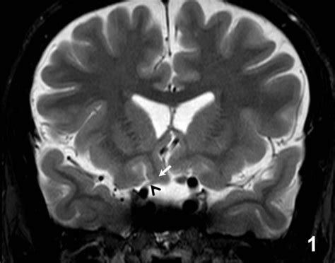 Congenital Herniation of the Gyrus Rectus Resulting in Compressive ...