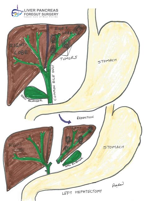 Resection Of Colorectal Liver Metastasis Crlm Liver Pancreas