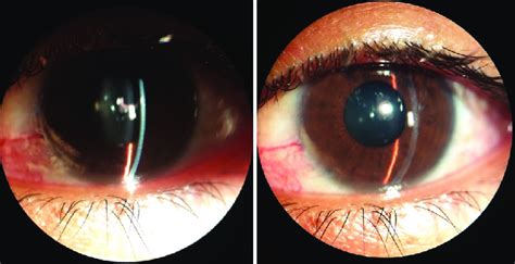 Slit Lamp Biomicroscopy Anterior Segment Image Showing The Narrow