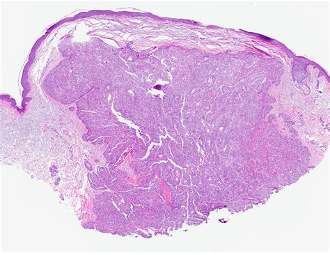 Cutaneous Clear Cell Hidradenoma Mayo Clinic Proceedings