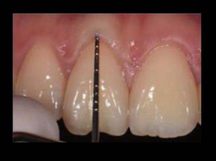 Ch Mucogingival Deformities And Conditions Around Teeth Flashcards