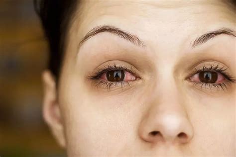 Eye Twitching During Pregnancy Signs Causes And Remedies