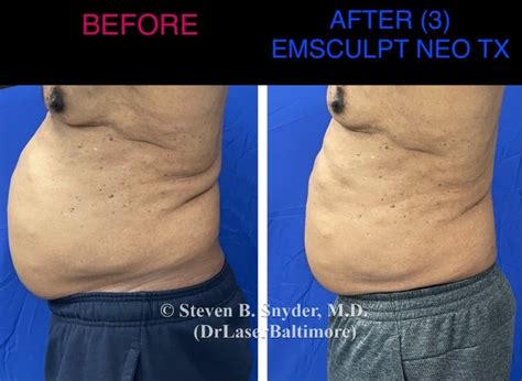 Emsculpt Before And After Real Patient Results, 43% OFF