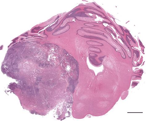 Cerebellar Medulloblastoma Sub Gross Appearance Of A Moderately