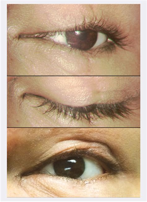 Figure 1 From Hard Palate Graft For Repair Of Eyelid Notch Deformity